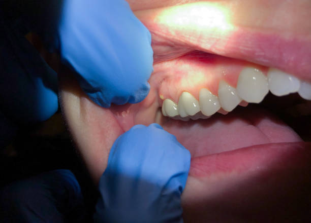 Best Broken Tooth Emergency  in Lakes East, CT